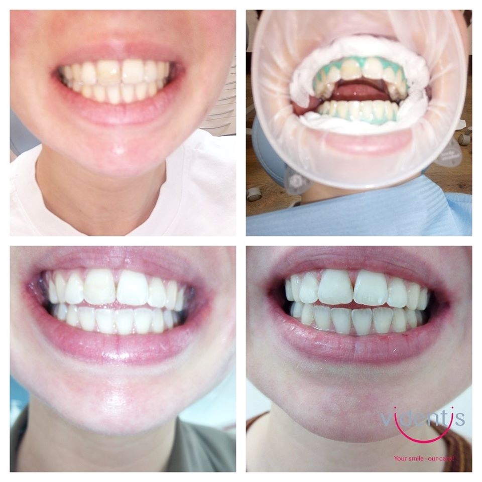 Rezultati izbjeljivanja zubi