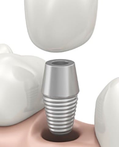 videntis-zubar-zagreb_zubni-implanti