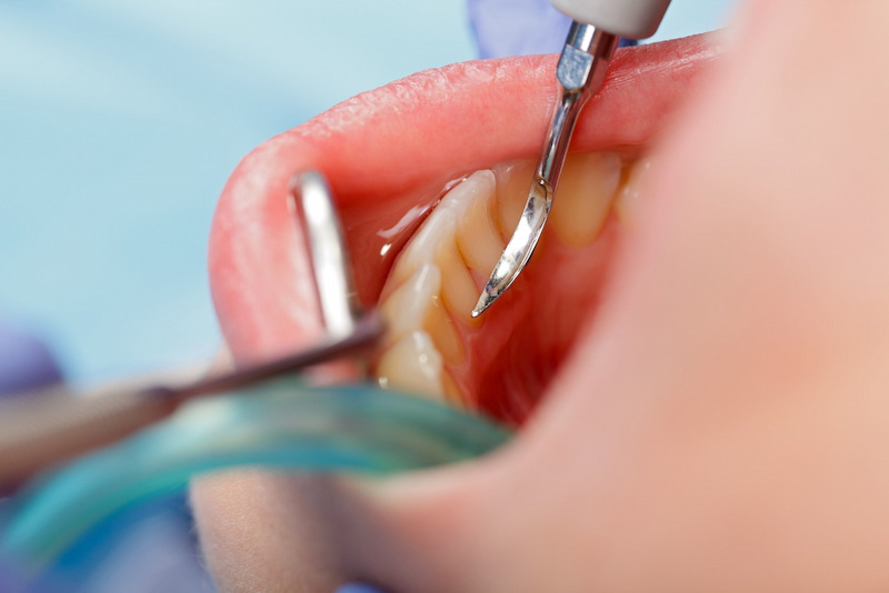 Čišćenje zubnog kamenca - Videntis Dental Centar
