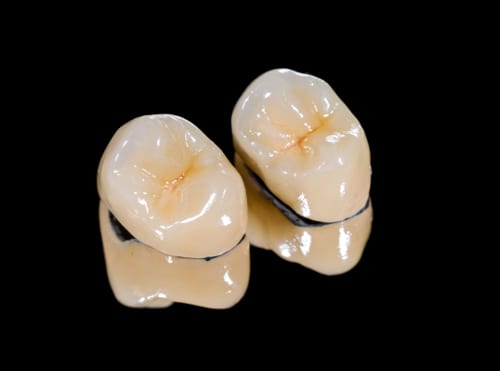 Zubna metalkeramika​