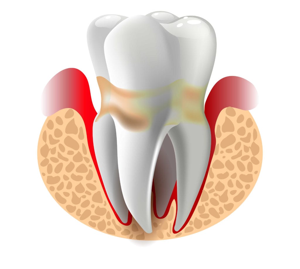parodontitis-videntis-stomatolog