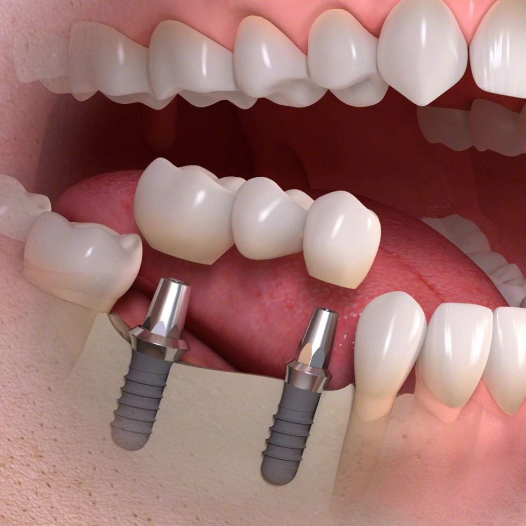 Zašto su zubni implantati dobri