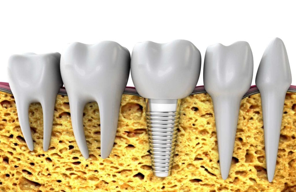 zubni-implantat-Videntis