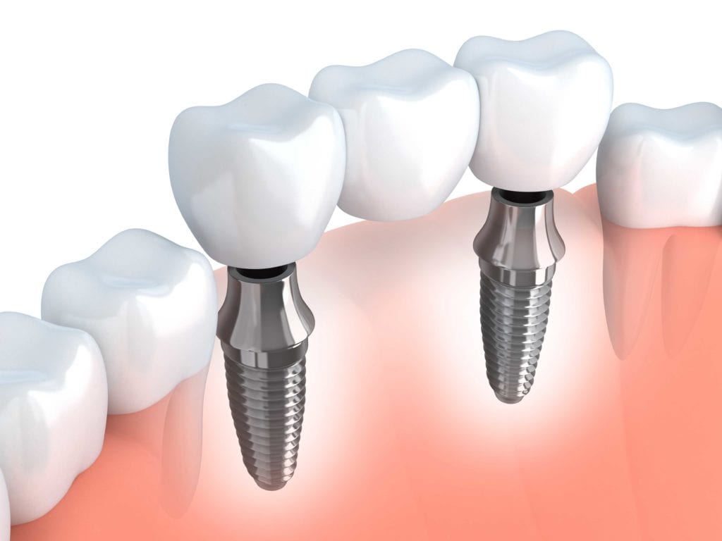 Zubni most na jednom ili na više implantata