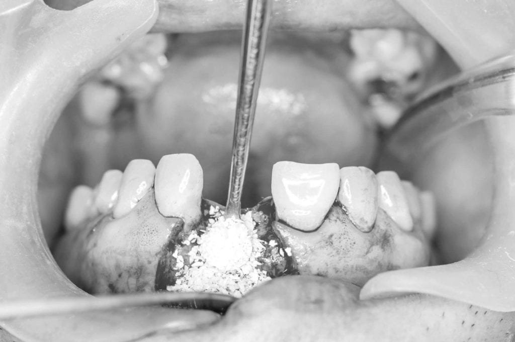 nadogradnja-kosti-zubni-implantat