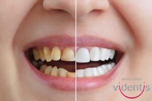 [vdc] [multimedia] [blog posts] krunice za zube, tj. navlake za zube kompletan vodič